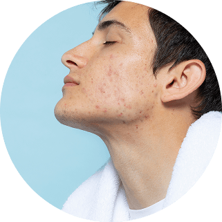 Anti-Acne Treatments